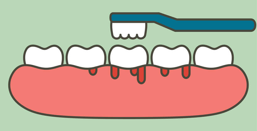 خونریزی لثه